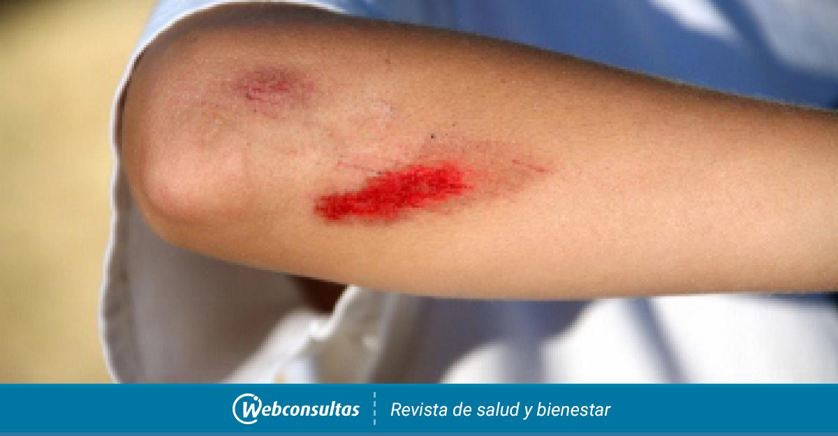 Tipos De Heridas 6806